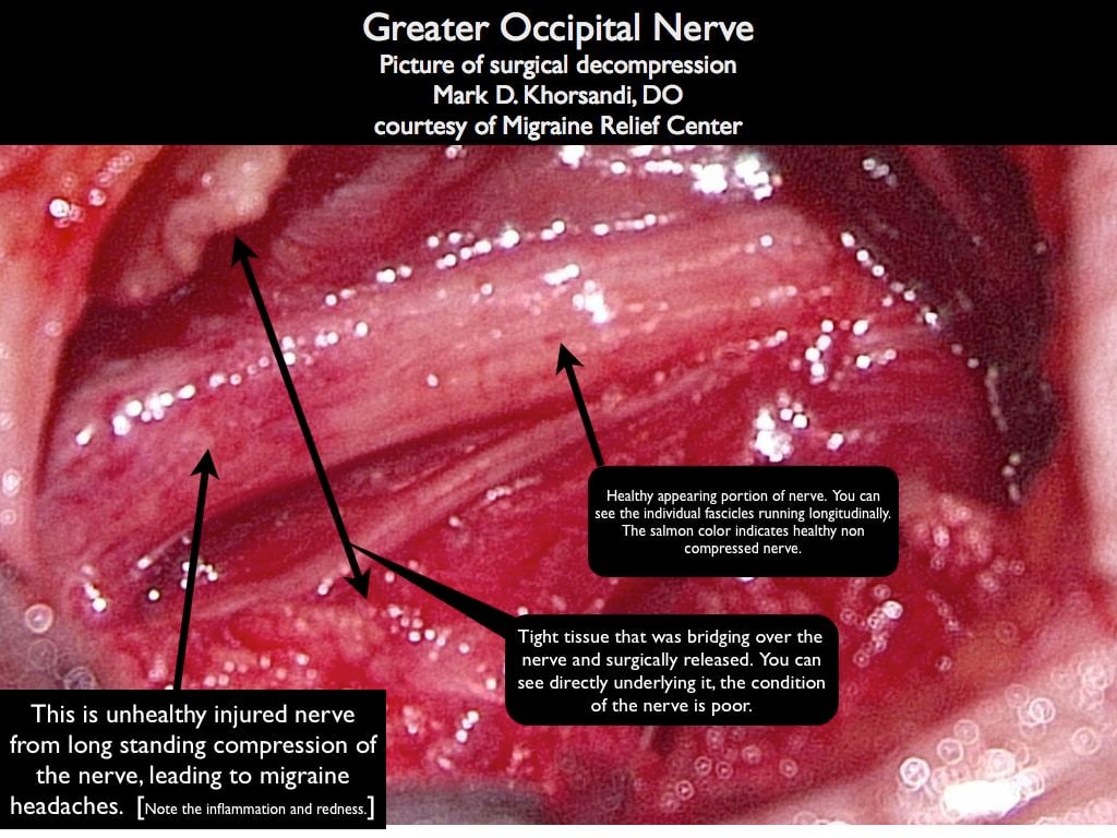 Greater_occipital_nerve.001