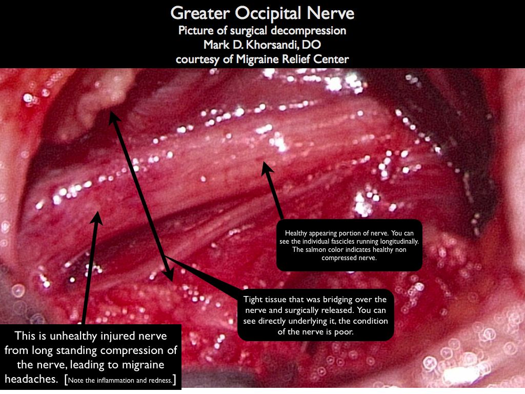 Occipital Neuralgia A Cause Of Migraine Headaches